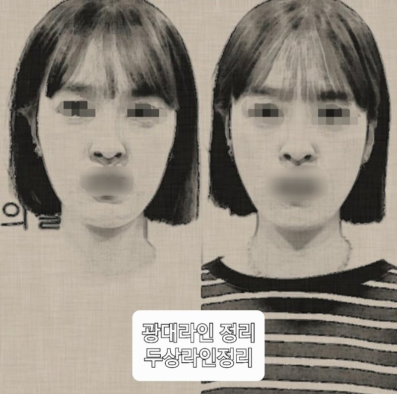 본테라피